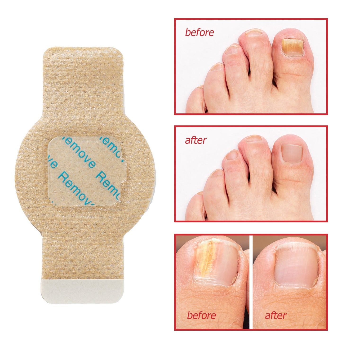 FungGone – Nail Repair Patches