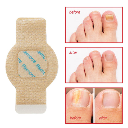 FungGone – Nail Repair Patches