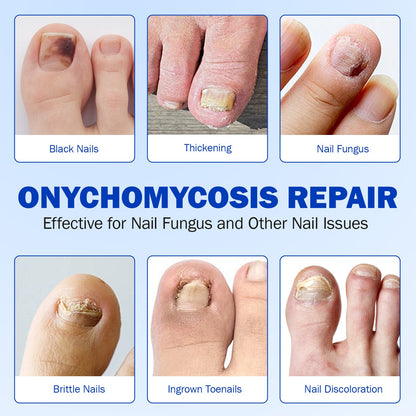 FungGone – Nail Repair Patches